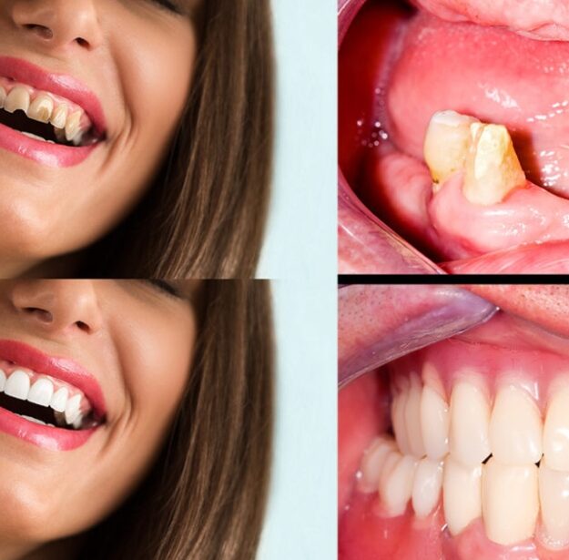 Mouth Rehabilitation إعادة تأهيل الفم