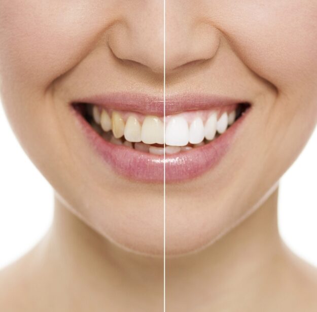 ابتسامة هوليوود hollywood smile